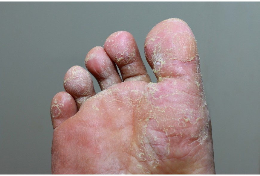 Piede d'atleta Tinea Pedis